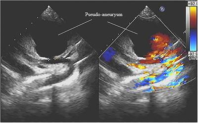 Case Report: Ascending Aortic Pseudo-Aneurysm Following Ventricular Septal Defect Repair in a 4-Year-Old Girl